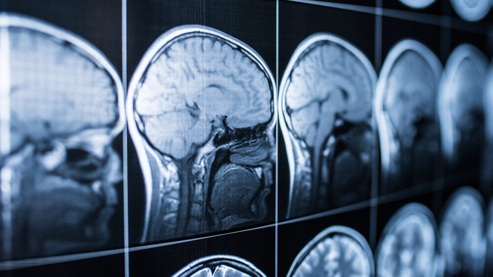 White Plains Traumatic Brain Injury Lawyers